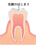 虫歯のはじまり