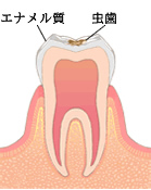 初期むし歯