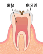 進行したむし歯