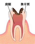 歯髄まで進行した虫歯