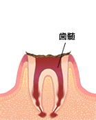 歯質が失われた歯