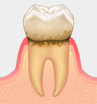 歯肉炎