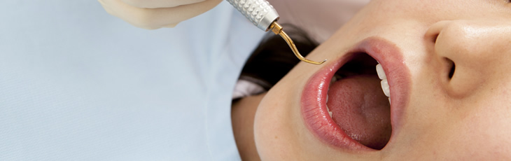 歯科治療イメージ