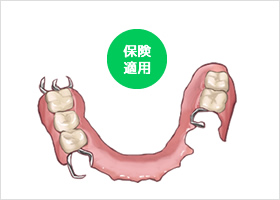 部分入れ歯のイメージ